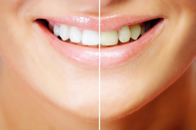 Ne belite si glave zaradi rumenih zob, saj bo EAER metoda pokrivala tudi storitev beljenja.