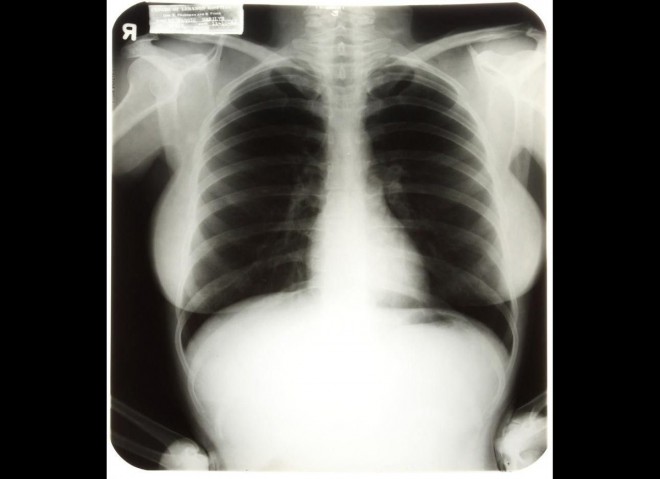 Røntgen af thorax af Marilyn Monroe.