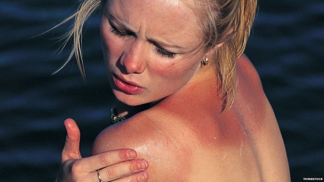 Sunburn can quickly turn a summer vacation into a nightmare.