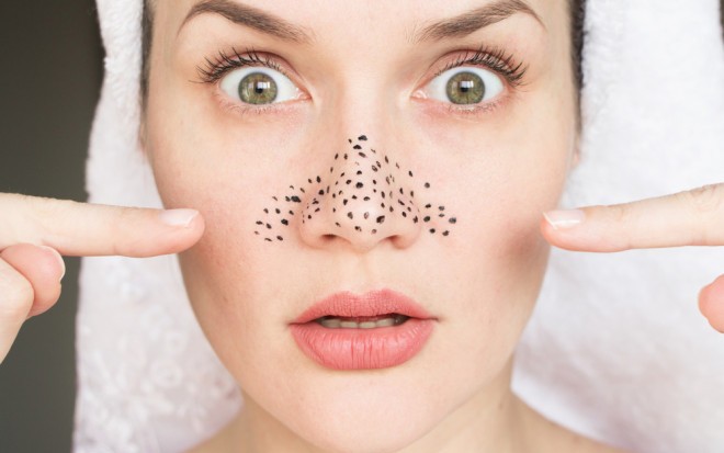 It may be better to buy a good cleansing gel rather than blackhead masks.