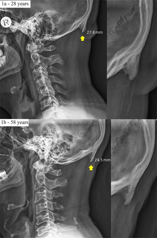 Exemple de radiographies de deux hommes (un homme de 28 ans et un homme de 58 ans) et des enthésophytes plus gros.
