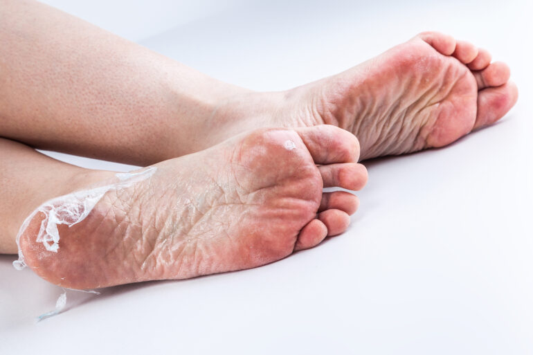 علاج فعال لفطريات القدم